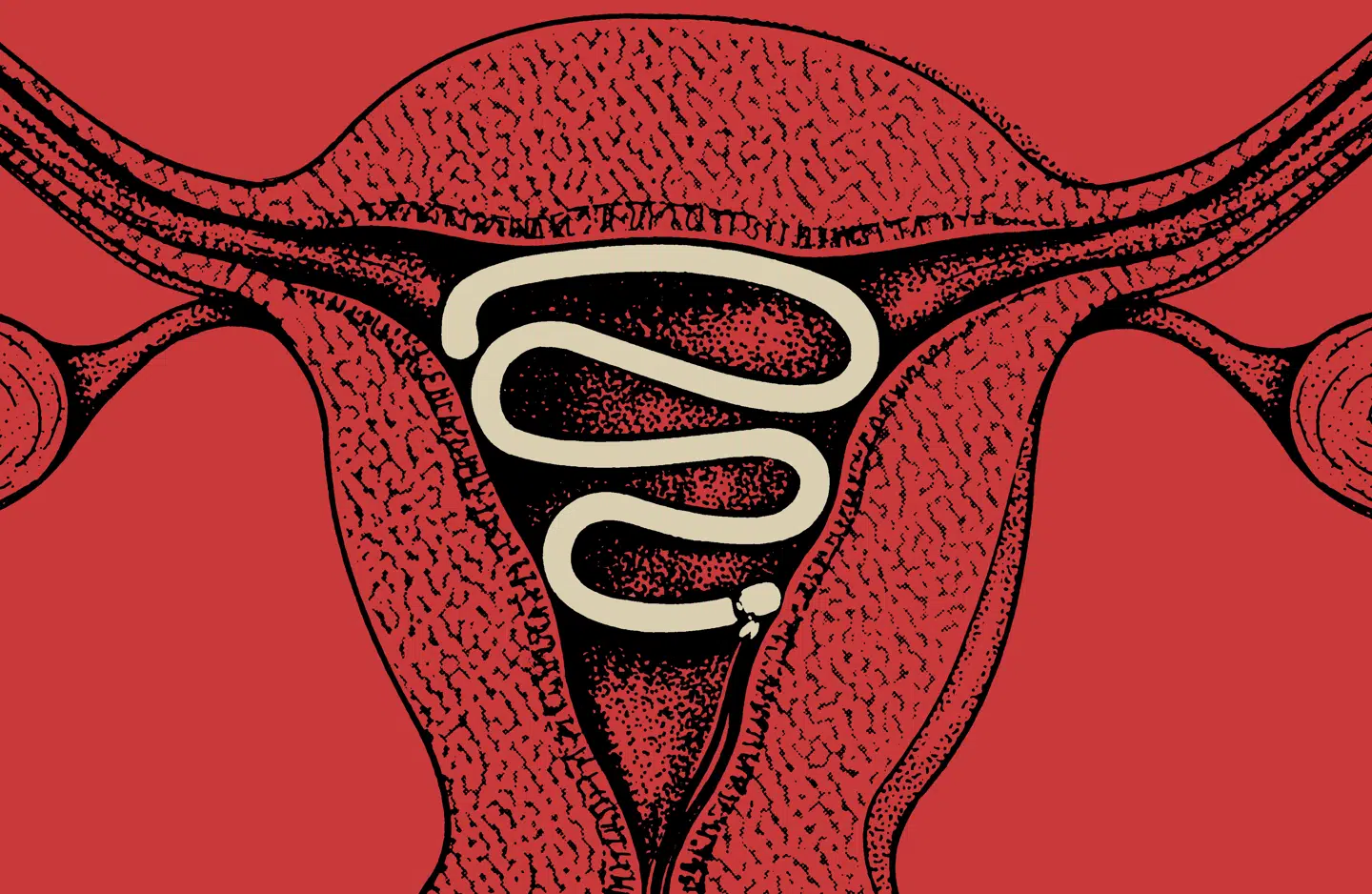 Mindst 4070 grønlandske kvinder og piger fik opsat spiral fra 1966 til midten af 1970erne, viste en udredning fra september.