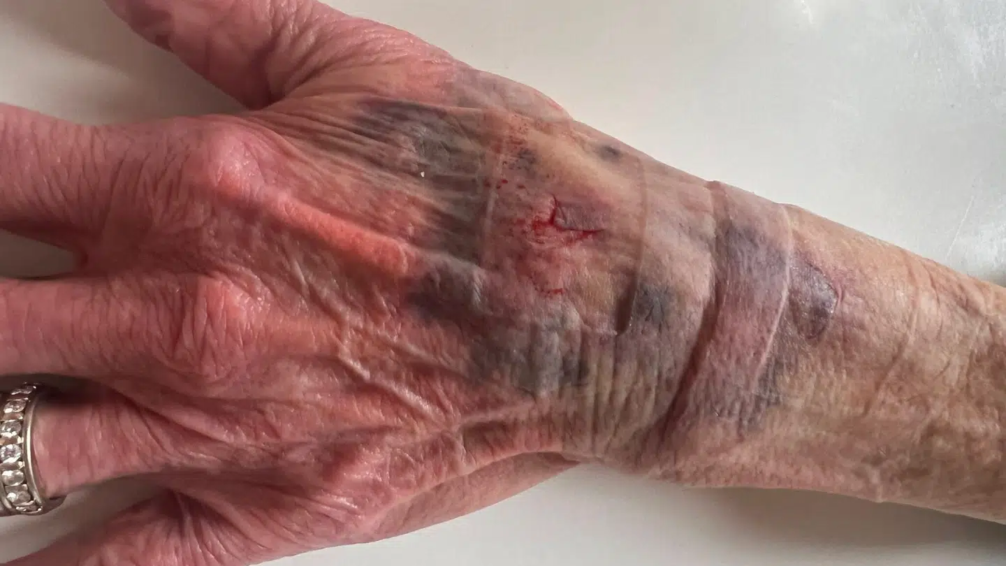 Her ses Lis' hånd efter røveriet