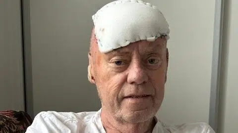 Claus efter skalpering: ‘Det var så smertefuldt’