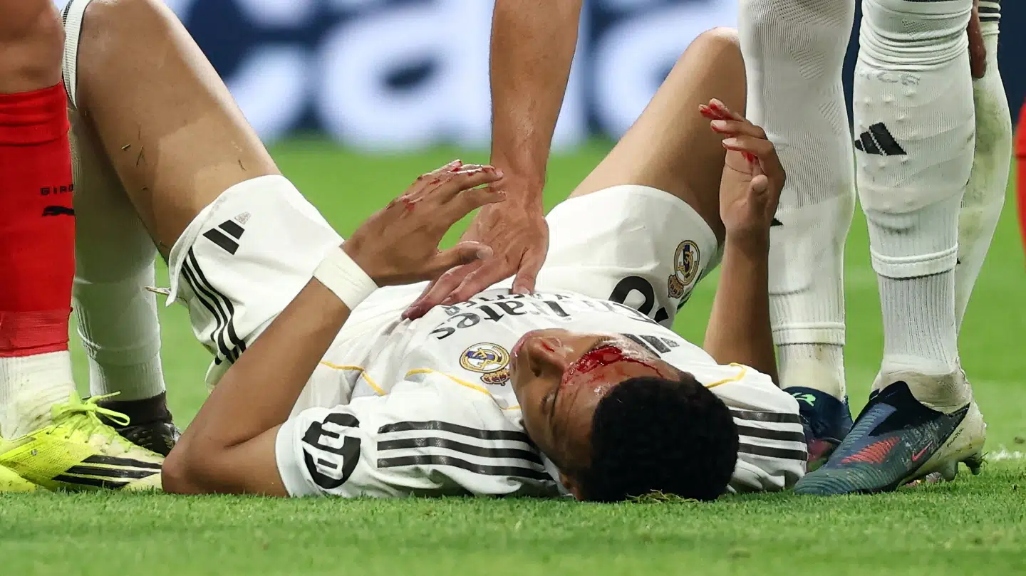 Mbappe blev slået til blods.