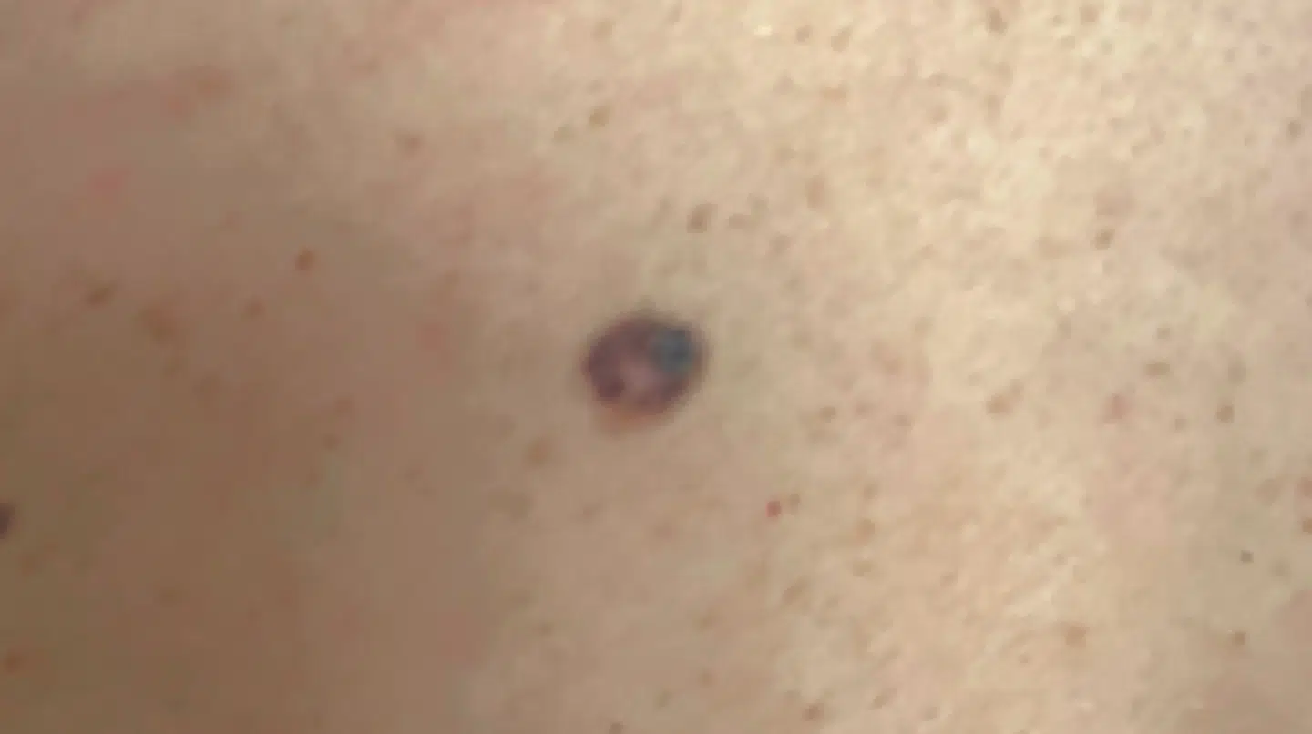 Her var det modermærke på Britt Olsens ryg, som viste sig at have kræft. Som man kan se på billedet, har det en ujævn kant og to forskellige farver – begge er mulige faretegn ifølge eksperter.