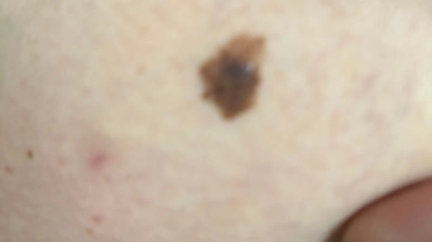 Lægerne fandt kræft i dette modermærke på Louise Randrups læg. Det viste sig, at det havde spredt sig til lymferne i lysken.