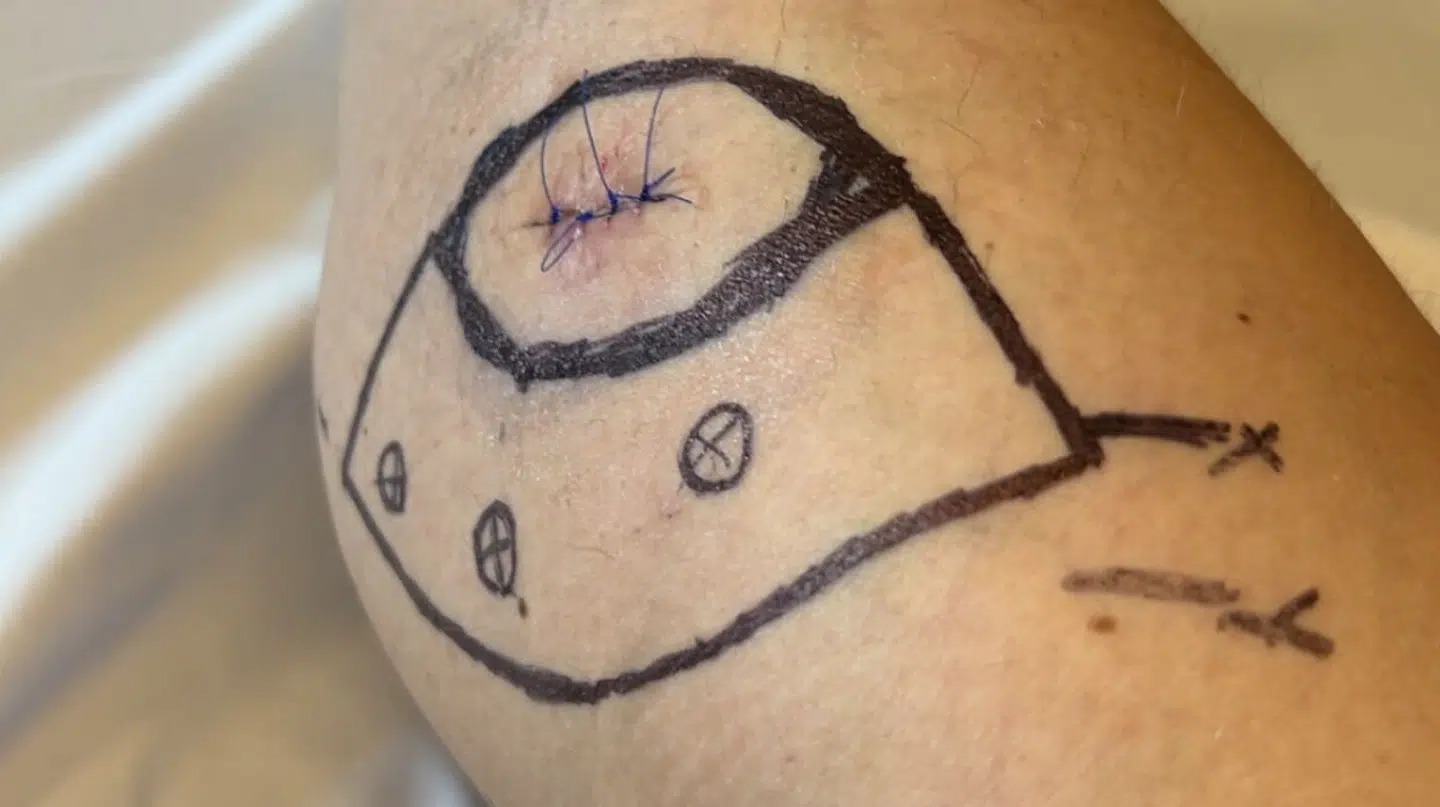 Sådan så det ud, efter Louise Randrup fik fjernet sit modermærke på læggen.