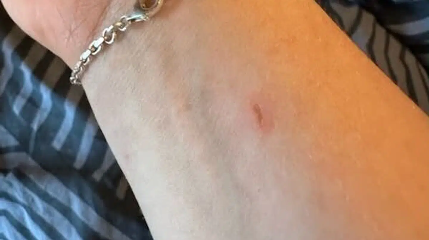 Her ses Charlotte Larsens håndled, som hun fik en lille forbrænding på under derbyet.