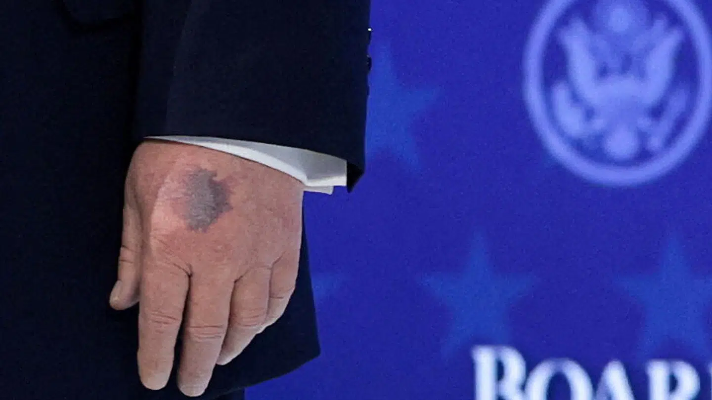 Donald Trumps blå mærker på hånden har vakt opsigt. Her ses han 22. januar 2026.