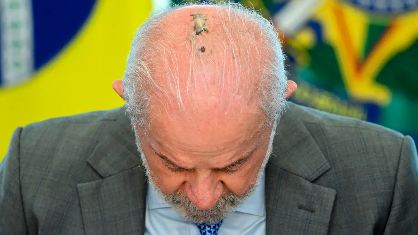 Brasiliens præsident, Luiz Inacio Lula da Silva, viser sit ar frem efter en operation sidste måned.