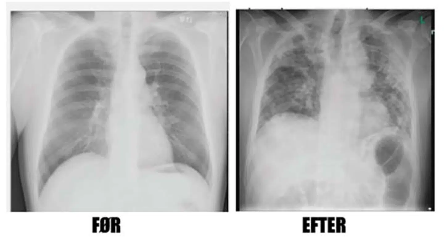 Billederne viser lungerne på en midaldrende dansk mand før og efter infektion af coronavirussen. Det første blev taget i 2014 i en anden sammenhæng, men det andet billede af de væsentlig mindre sunde lunger er taget, efter manden er blev udskrevet fra intensiv. Foto: SKA