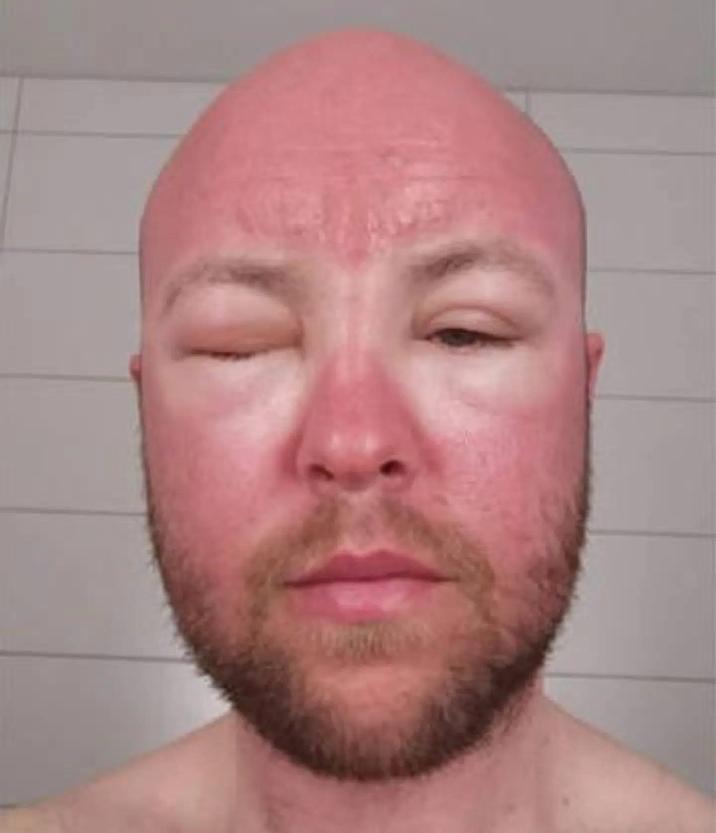 Lars Aunemo blev så solskollet under en skitur, at han fik andengradsforbrændinger i panden og hævelser i ansigtet..