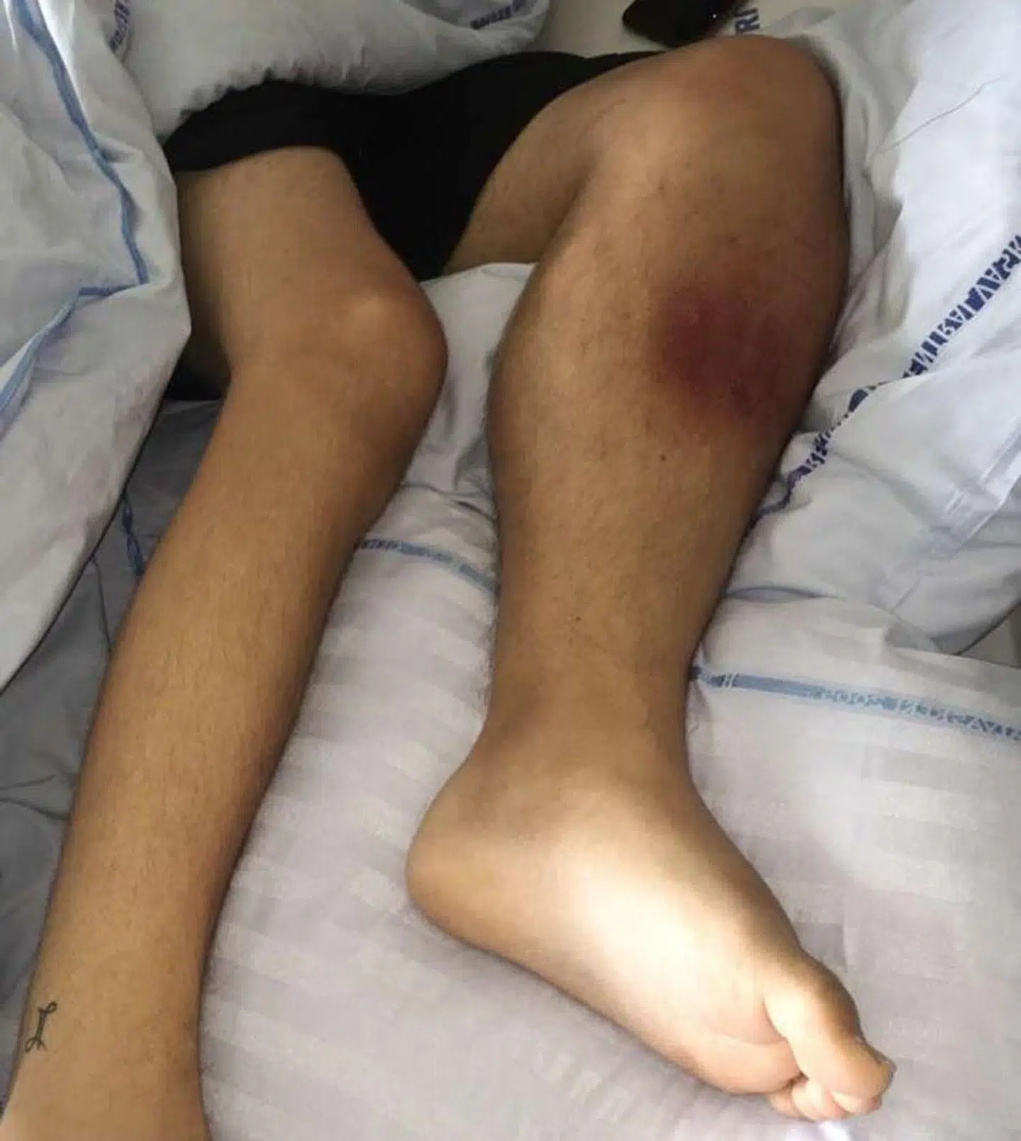 Rasmus' ben, før det blev amputeret. Han opsøgte læge mange gange, men først sent blev kræften opdaget, og benet måtte amputeres. Foto: Privat.