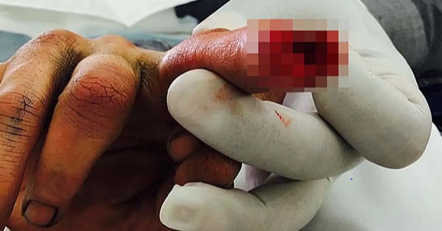 Johhny Depps skadede finger.