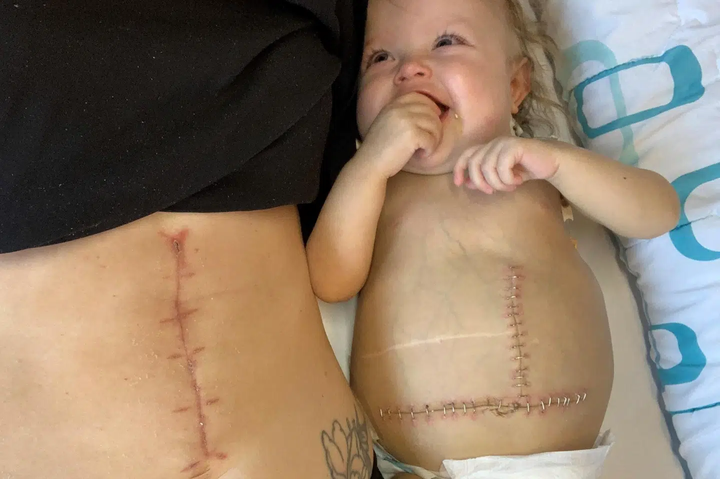 Mor og datter efter operationen. Foto: Privat.