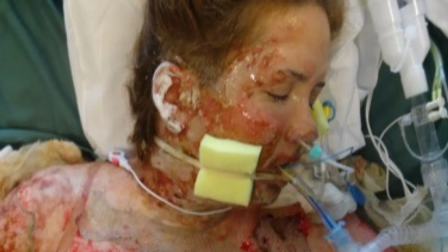 Hele den ene side af den dengang 26-årige kvinde var ramt af svære tredjegradsforbrændinger.