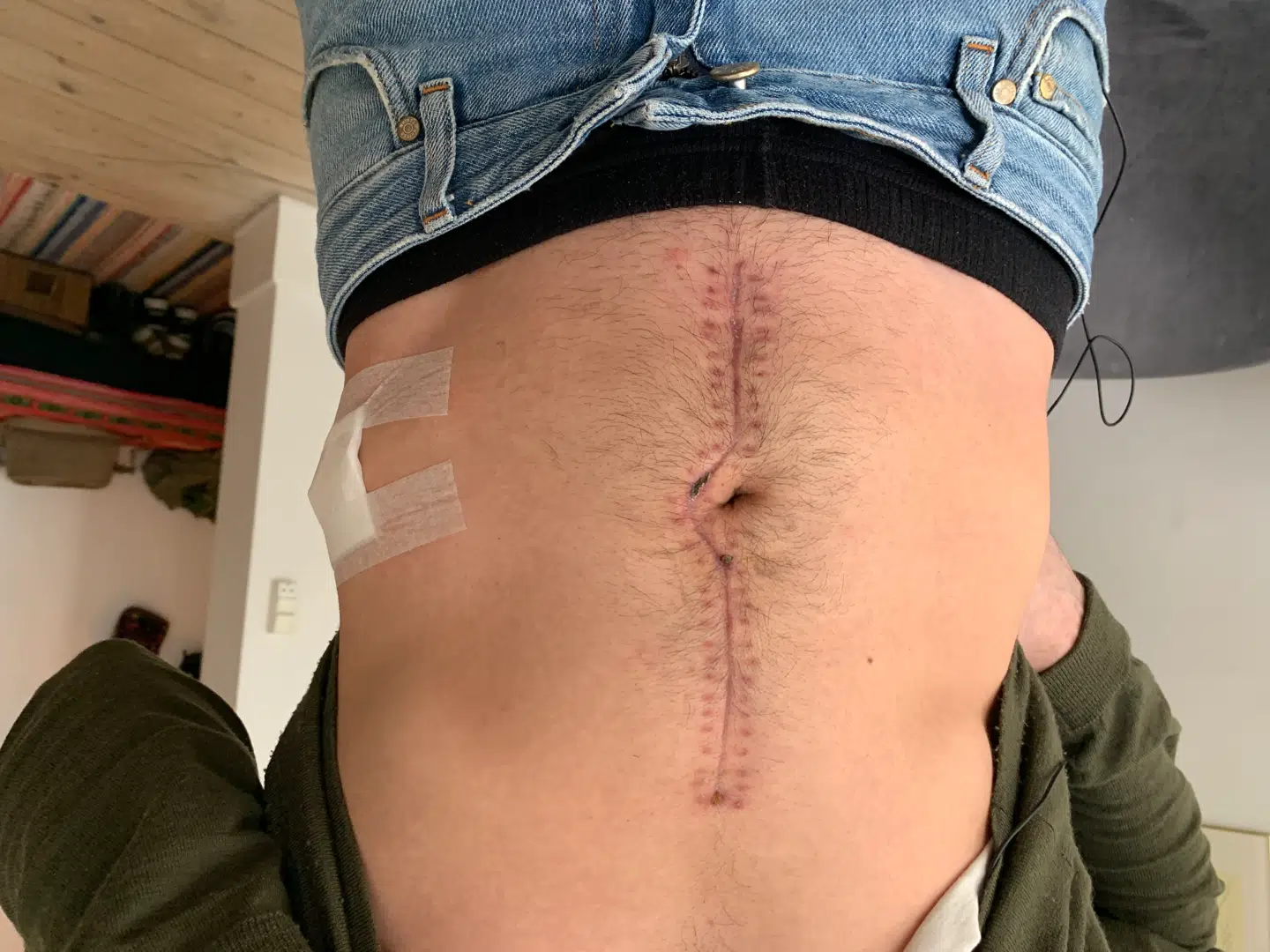 Martin Højlund blev lappet sammen med 31 metalklips efter den omfattende operation.