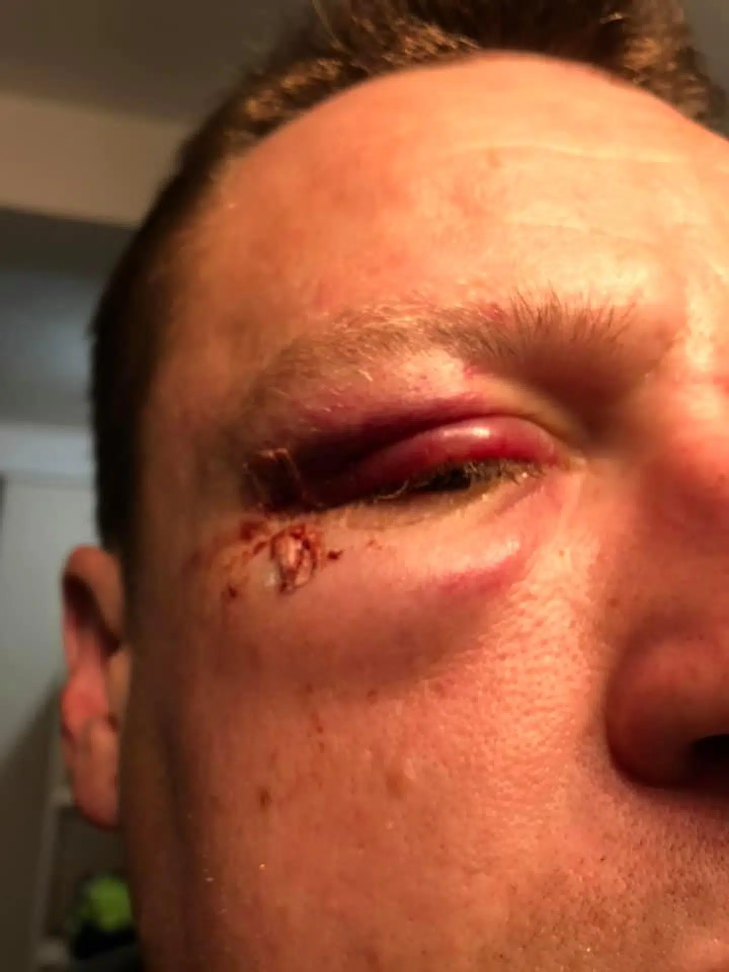 I dag kan Henrik Kring ikke kigge ud af sit højre øje, og han har kraftig hovedpige og skal en tur til fysioterapeuten med sin ømme skulder.