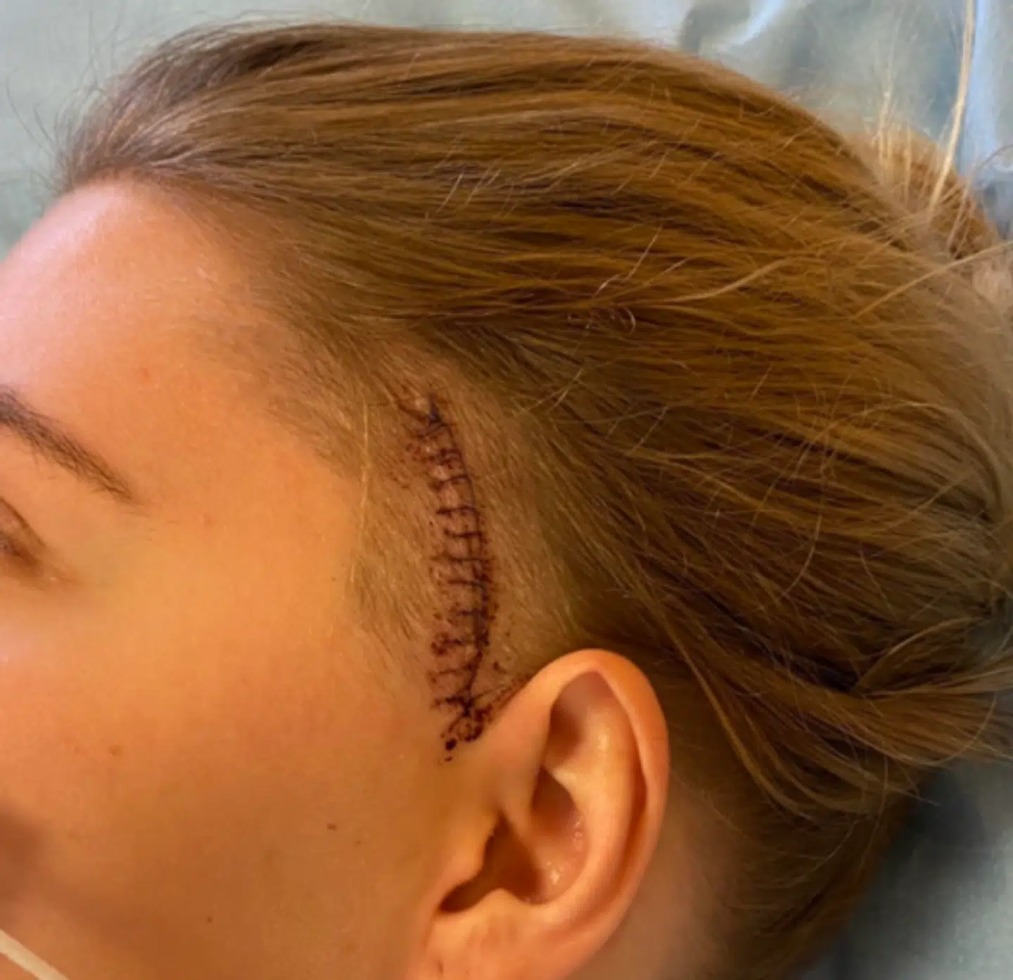 Her ses arret, efter Frederikka Vium blev opereret for betændt byld på Aarhus Universitetshospital. En byld hun havde udover sin meningitis. Foto: Privat