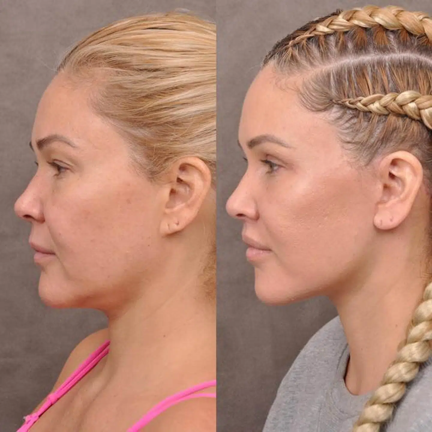Shanna Moakler (amerikansk realitystjerne og tidligere eks til Travis Barker og Oscar de la Hoya) før og efter sit ansigtsløft hos Ben Talei.