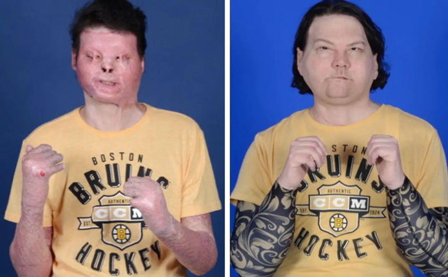 A combination of handout photos shows 22-year old Joe DiMeo before and after he successfully underwent a 23-hour long transplant surgery on August 12, 2020 at NYU Langone in New York for a new face and hands. NYU Langone Health/Handout via REUTERS THIS IMAGE HAS BEEN SUPPLIED BY A THIRD PARTY.NO RESALES.NO ARCHIVES.