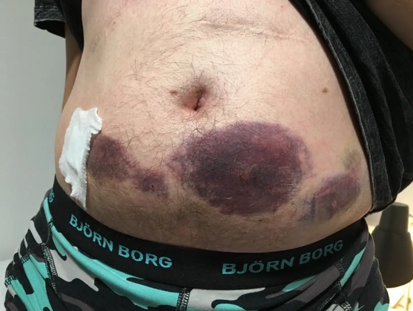Benjamin får blodfortyndende medicin, for at blodet skal flyde bedre i de forsnævrede vener, og det danner til tider store plamager af indvendige blodindsamlinger.