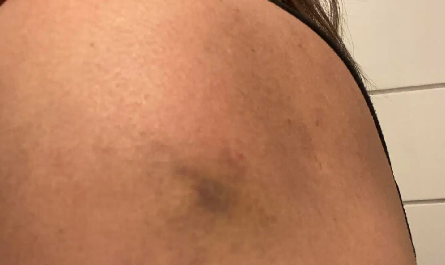 Merethes blå mærke efter vaccination.