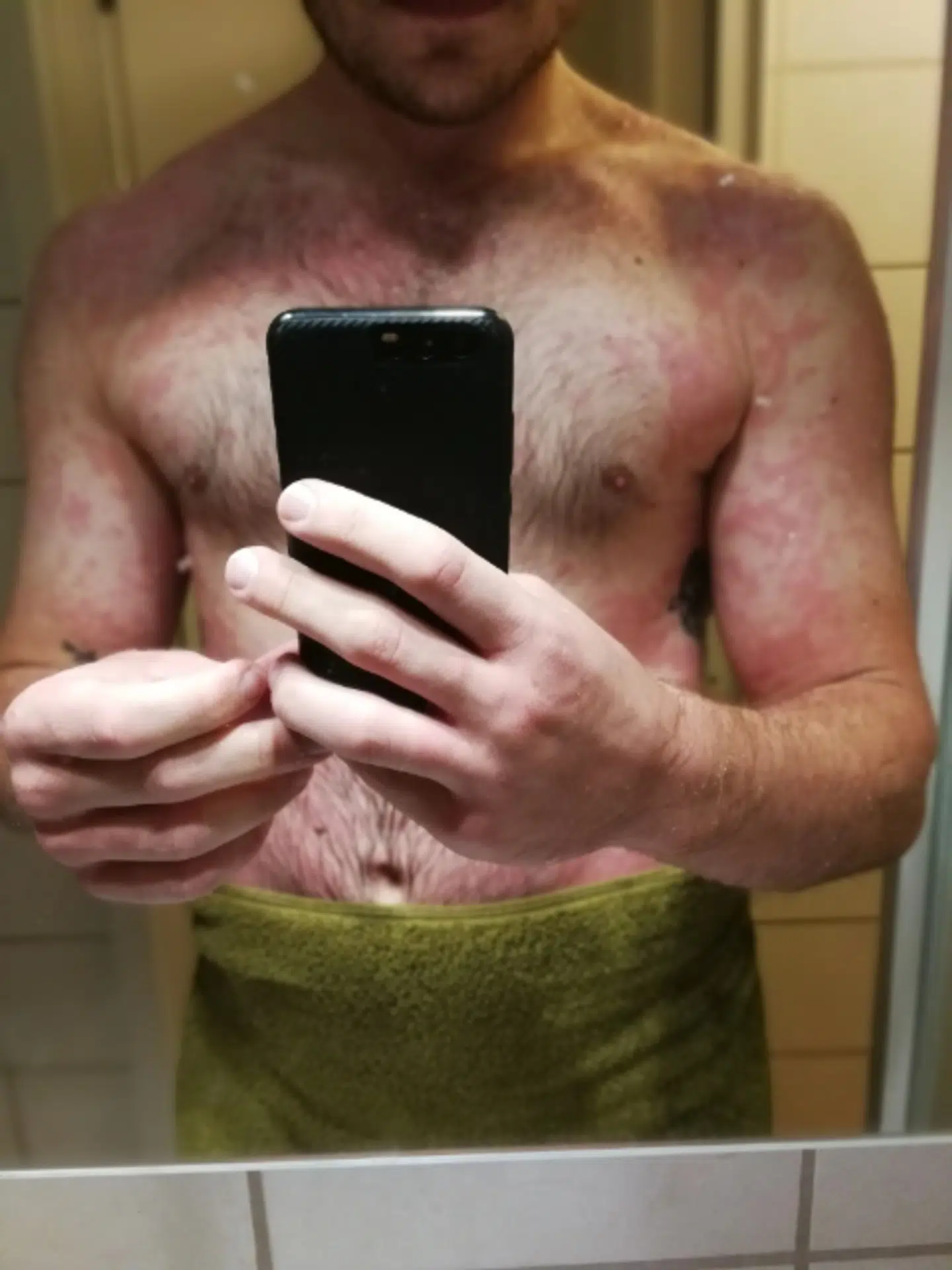 Her havde Kasper Jensen udslæt på omkring 90 procent af kroppen efter en allergisk reaktion på kød. Privatfoto.