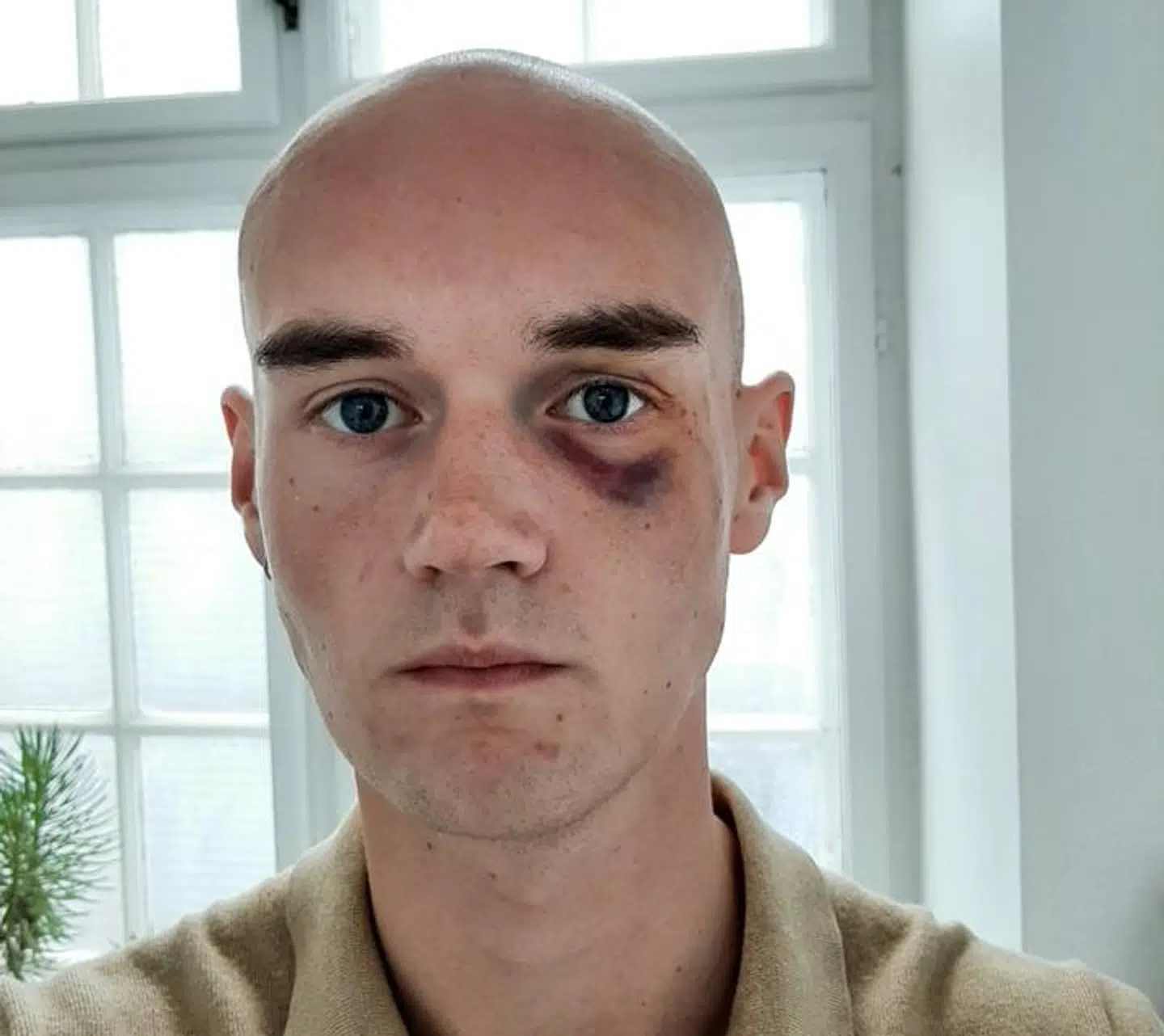 Frederik Fryland efter overfaldet.