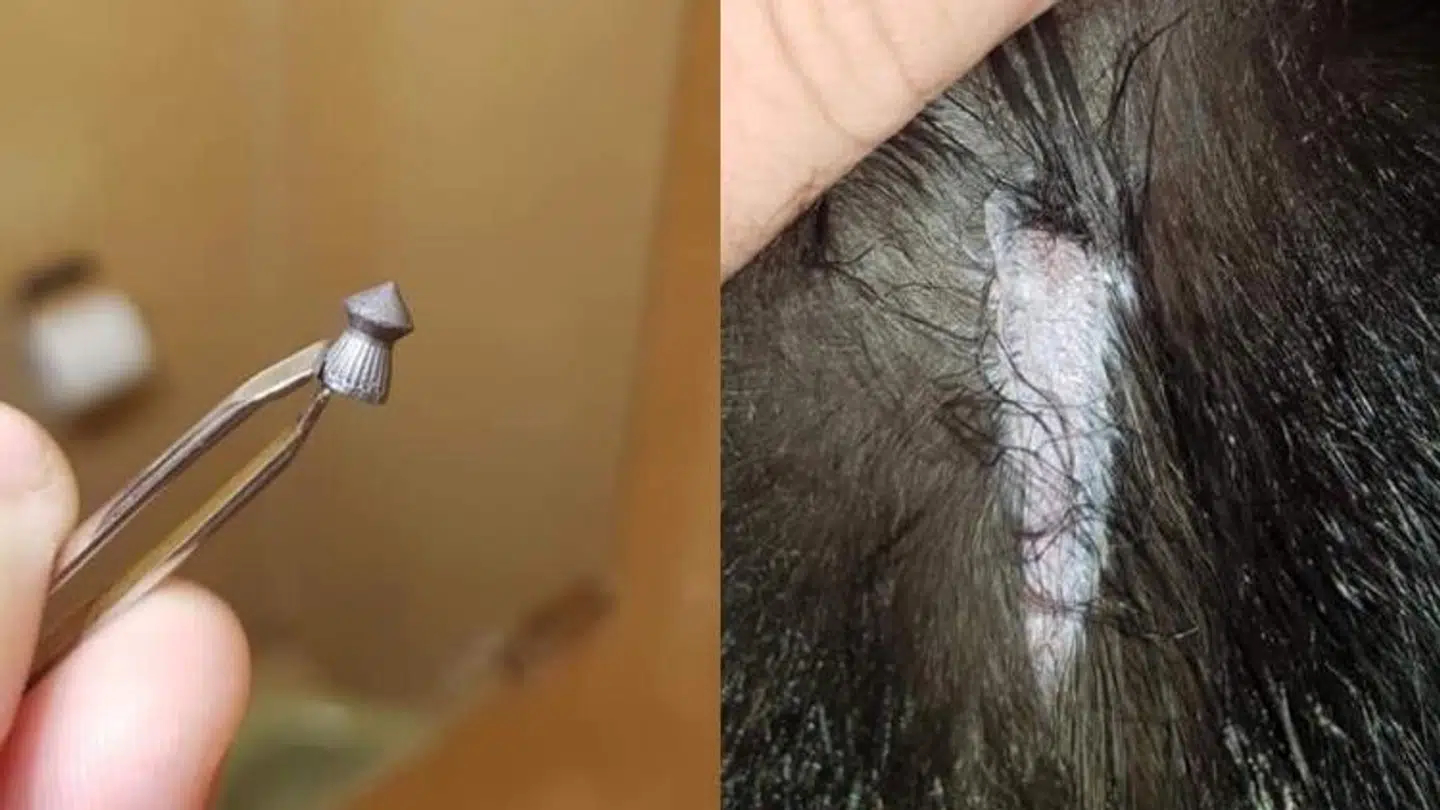 Til venstre ses haglet, der sad i Gordon. Til højre ses det aflange sår.