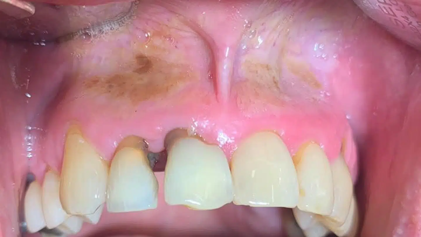 Brugen af snus kan have alvorlige konsekvenser.