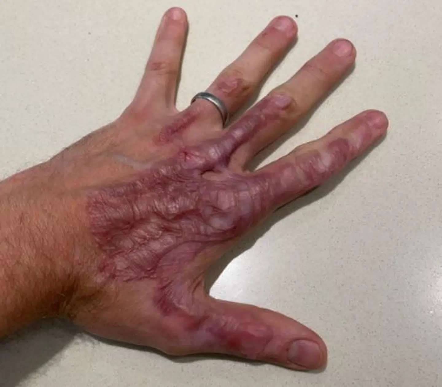 Romain Grosjeans venstre hånd.