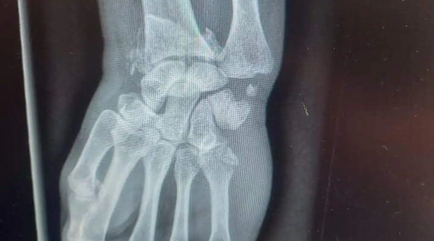 Dorthe Madsen brækkede sit håndled tre steder.