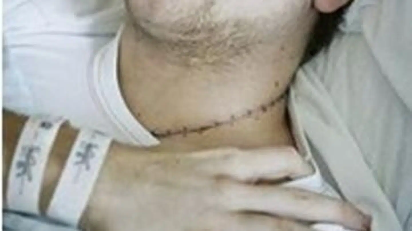 Kniven nåede 11 centimeter ind i halsen på Mikkel Salling Holmgaard. Privatfoto