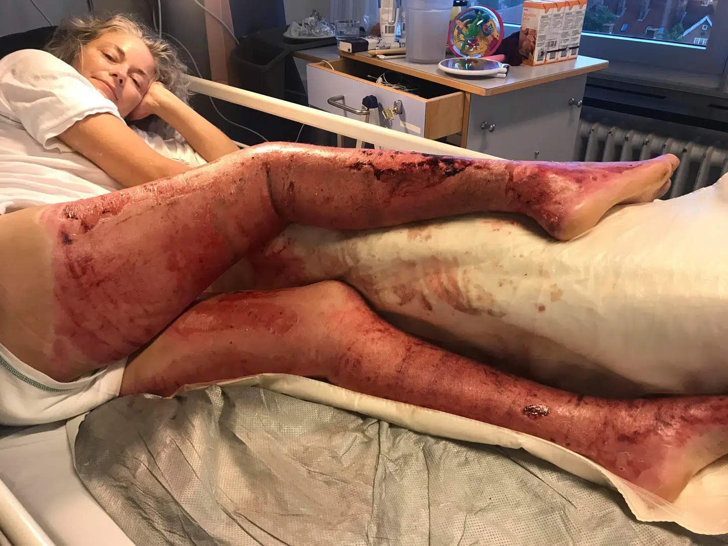 Begge Tine Bays ben blev forbrændt helt op til shortskanten.