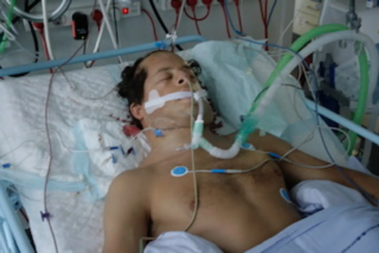 Jeppe fotograferet i hospitalssengen under sin koma (Privatfoto)