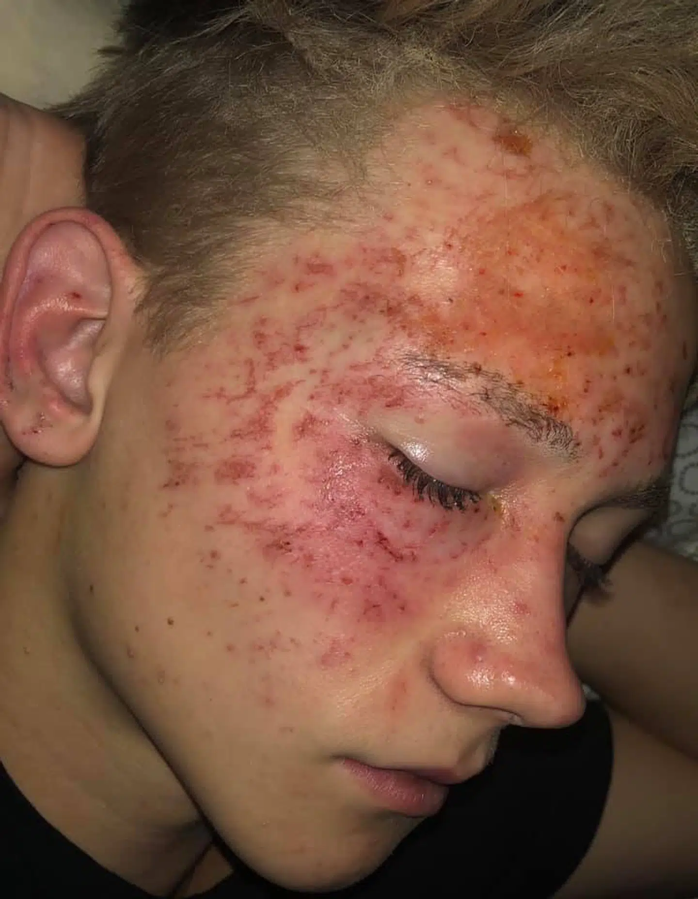 Markus fik sår i ansigtet og brændte øjenbryn, øjenvipper og hår i ulykken. Derudover har han fået ridser i øjnene, men lægerne siger, at det vil hele af sig selv.