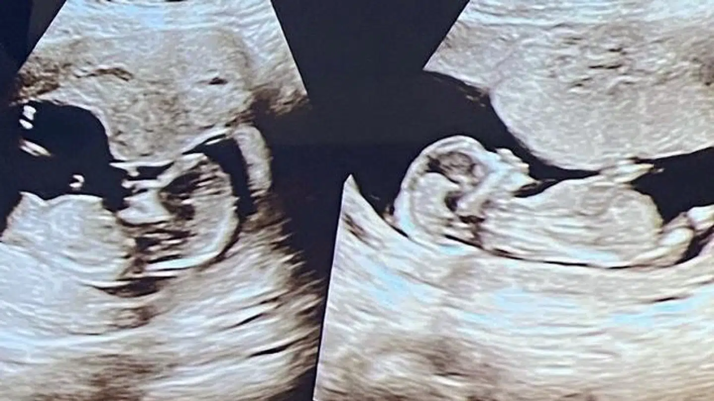 Dennis Knudsen skal være far til fire, bekræfter han over for B.T., efter han fredag lagde disse skanningsbilleder op på sine sociale medier.