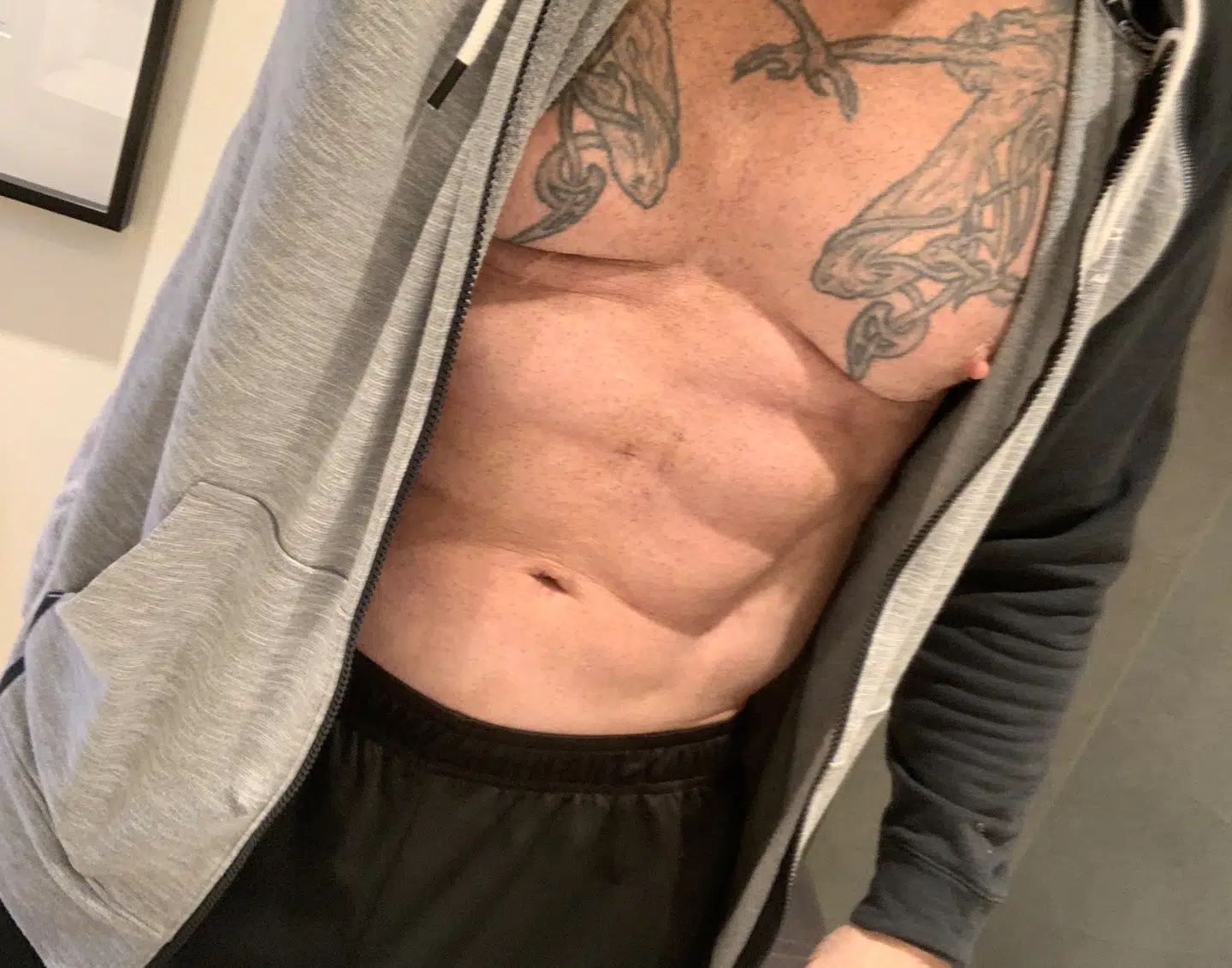 Kim Novaa en uge efter operationen. Foto: Privat.