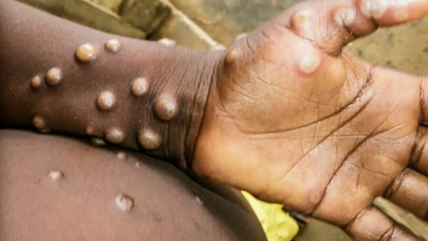 Foto: WHO/Nigeria Centre for Disease Control