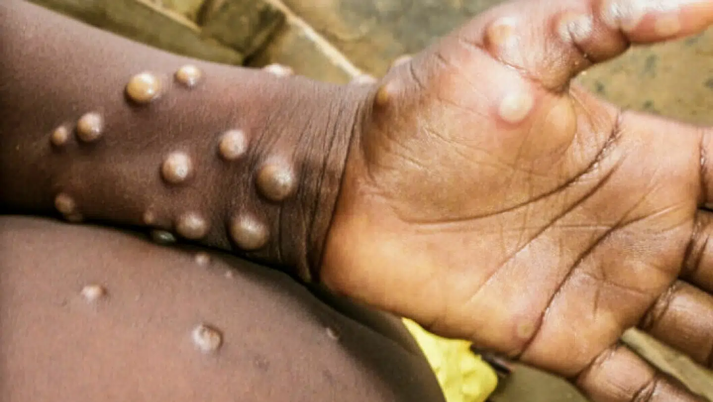 Foto: WHO/Nigeria Centre for Disease Control