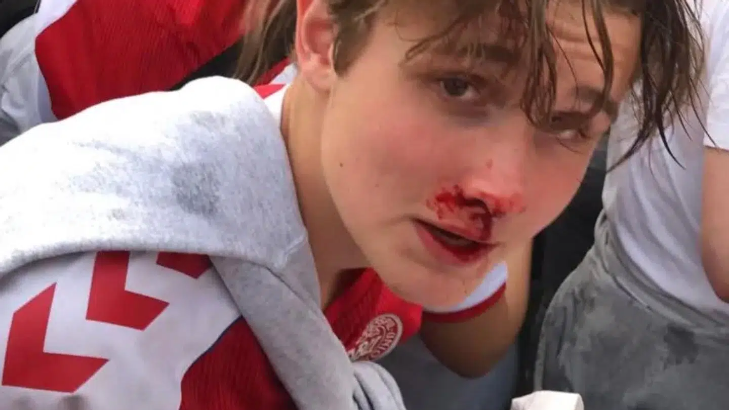 Lasse Lillegaard efter at være blevet ramt af en fyldt øldåse.