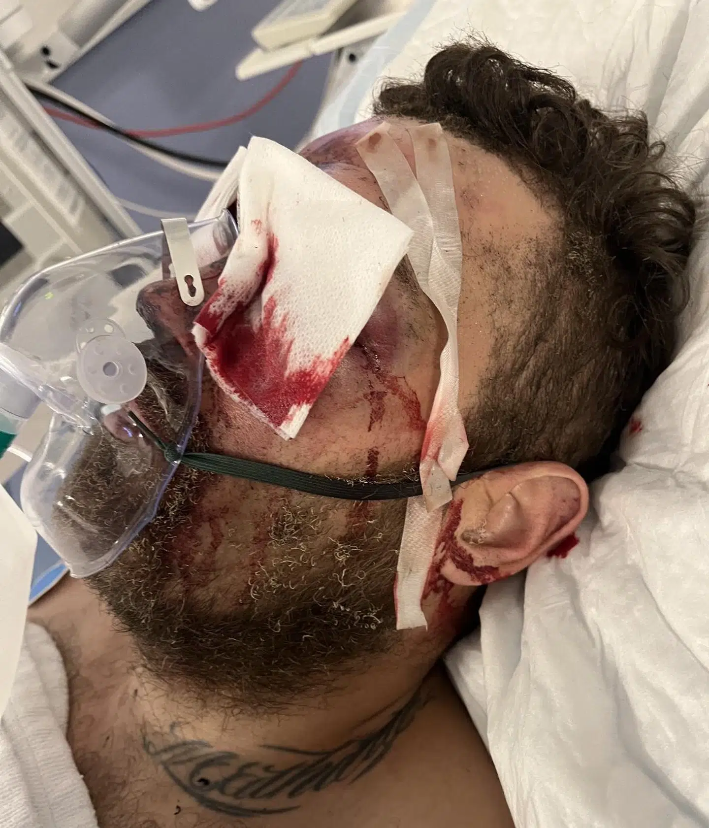 Morian på Rigshospitalets traumecenter efter den første otte timer lange operation