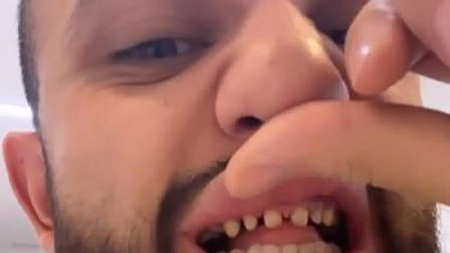Mahmoud Ismail fik sine tænder filet helt ned til små stumper, så han kunne få påsat porcelænsfacader. Foto: Instagram