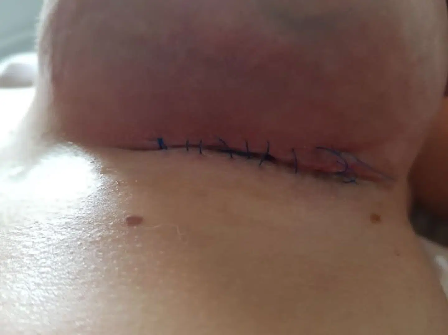 Cecilie Mortensen tog billedet af sit sår, lige efter at hun blev syet uden bedøvelse. I alt syede kirurgen Waseem Ghulam hende mellem 9-10 sting uden bedøvelse.