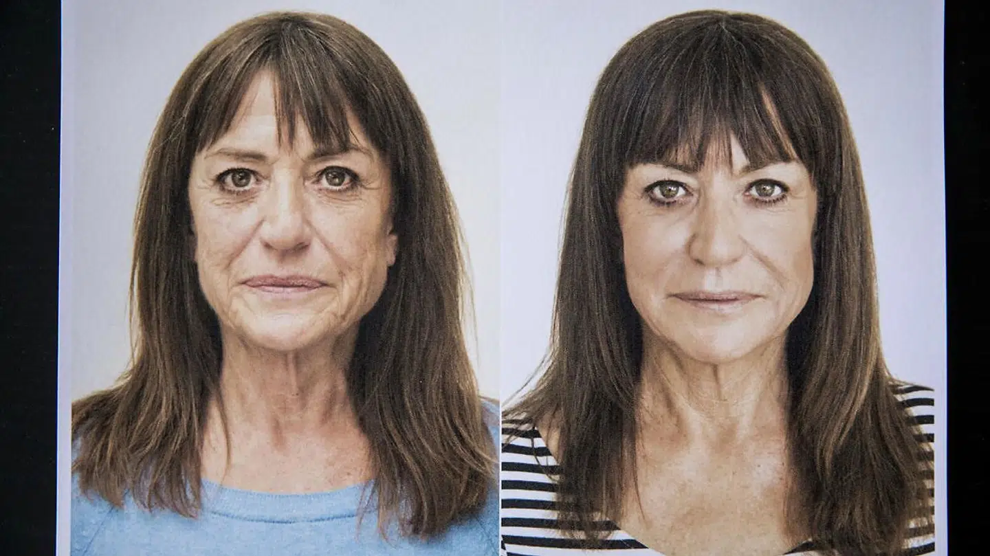 Kvinden på billedet har fået såkaldt 'fraktioneret CO2 laser' samt Botulium Toxin (botox) mellem bryn og i pande. Fraktioneret C02 er en optimal behandling for solskader og kan behandle hele ansigtet inklusiv øjeområdet, hals og øverste del af brystet. Behandlingen udføres af en læge.