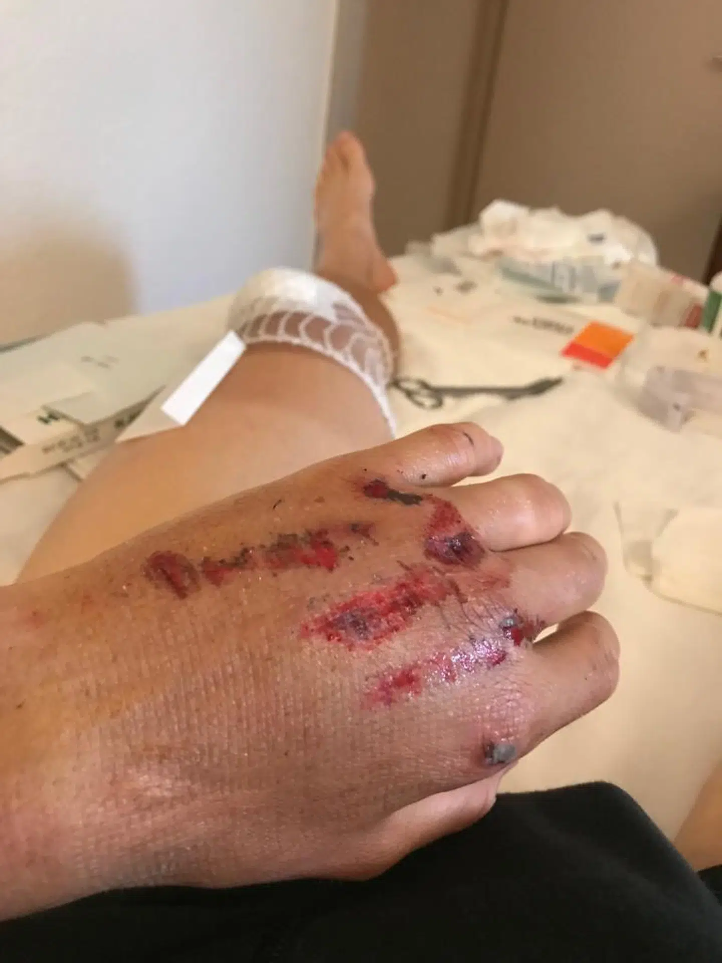 Sådan så Jakob Fuglsangs hånd ud efter det voldsomme styrt, der kostede ham den videre deltagelse i årets Tour de France.