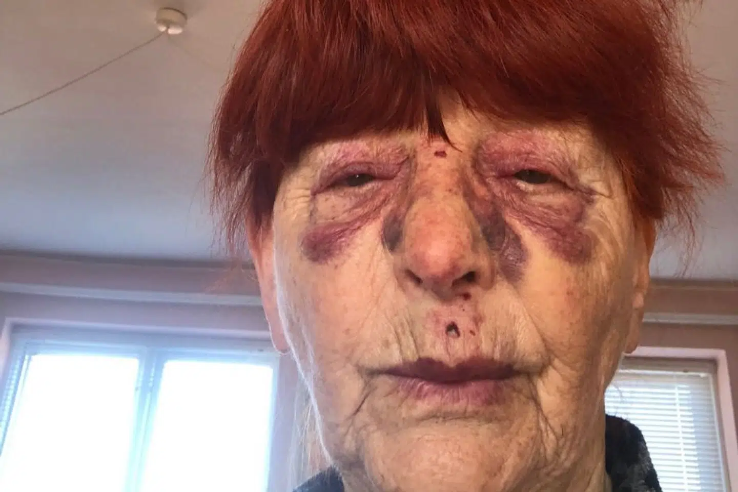 81-årige Lis Bech fra Rønne efter hun fik låg fra flaskekar i hovedet ude foran Netto