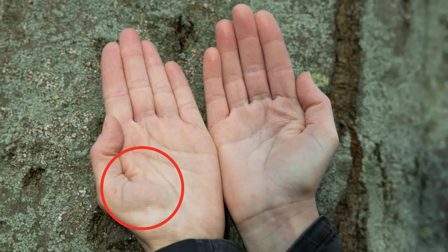 Betina Engelbrechts muskel i venstre hånd er ødelagt for altid, efter hun prøvede en ny behandling for sin sygdom.