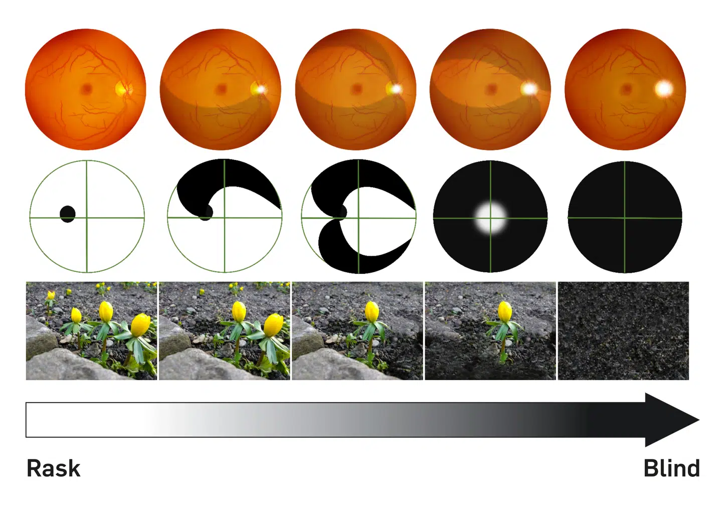 Denne illustration fra Øjenforeningen viser, hvordan synet gradvist forringes ved grøn stær. Knud Romers syn befinder sig p.t. mellem sidste og næstsidste punkt.