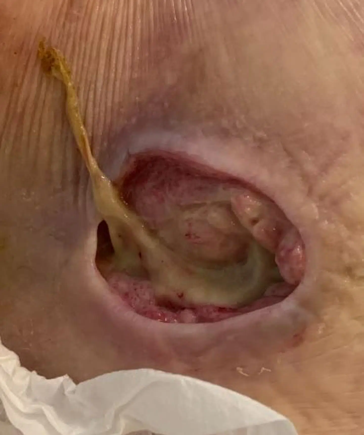 Tryksår inddeles i fire kategorier. Kurt Hedelunds sår endte som den værste – dyb vævsskade, hvor man kan se ind til sener og kød.