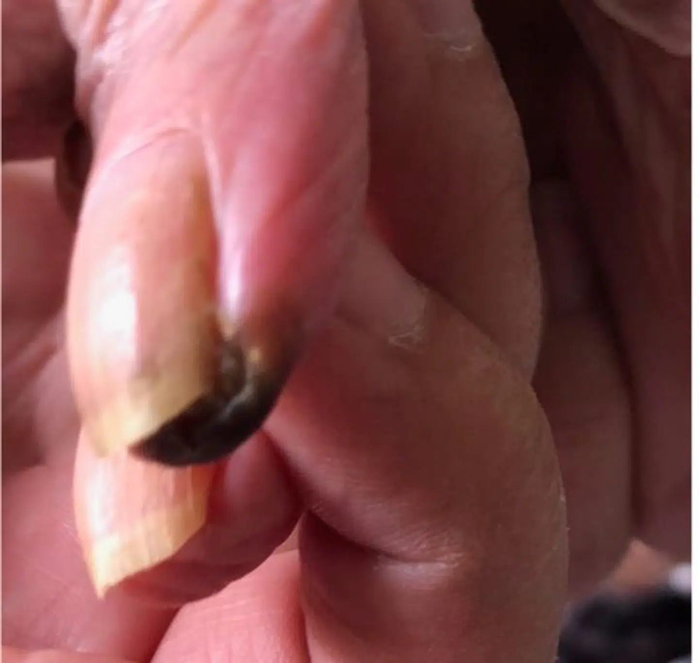 Kurts familie opdagede ved et besøg, at der var gået koldbrand i en af hans fingre. Det kom bag på personalet, som ikke havde opdaget det. Familien mener derfor, at de slet ikke har været opmærksomme på Kurt Hedelunds helbred.