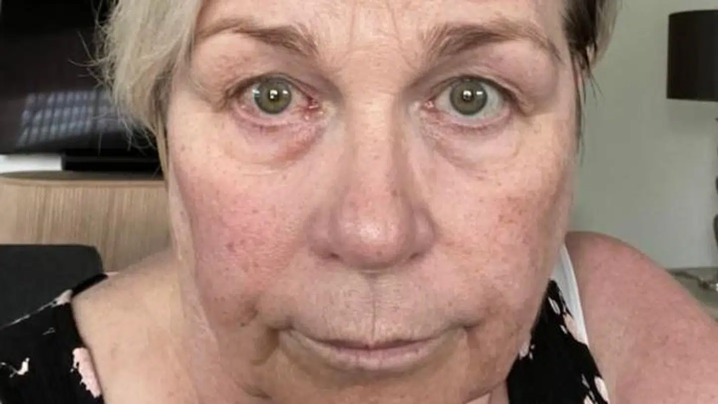 Især det højre øje har været irriteret, fortæller Lesley Lauridsen.