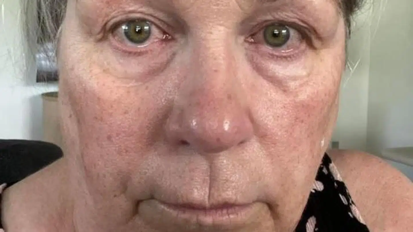 Lesley Lauridsen oplever fortsat rødsprængte øjne efter coronasmitte.
